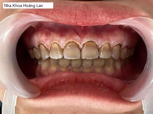 Yến Sào Vĩnh Phúc - Gợi ý 15 Nha Khoa tốt nhất khu vực Huyện Lập Thạch (Cũ)